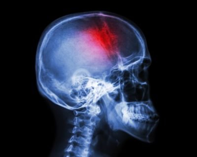 Traumatic Brain Injury Xray